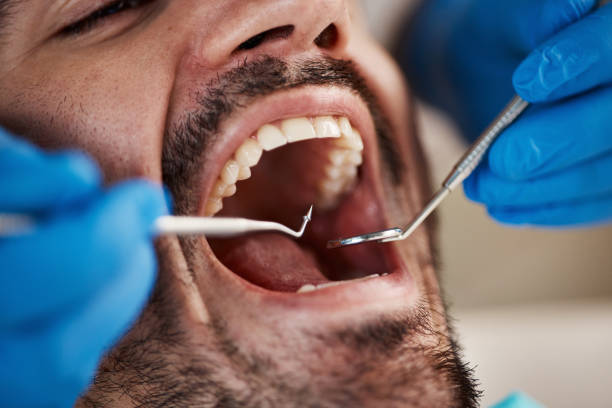 Best Emergency Tooth Extraction in Granite, OK